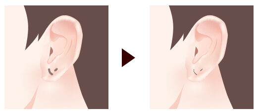 ピアス穴の修正