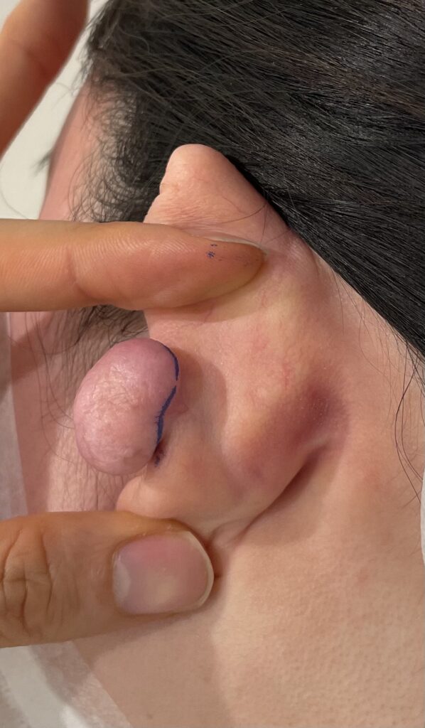 耳のケロイド 裏面