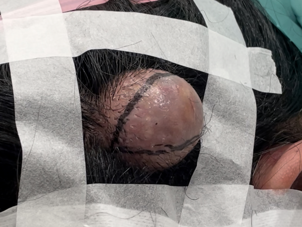 頭部の粉瘤　切開ライン