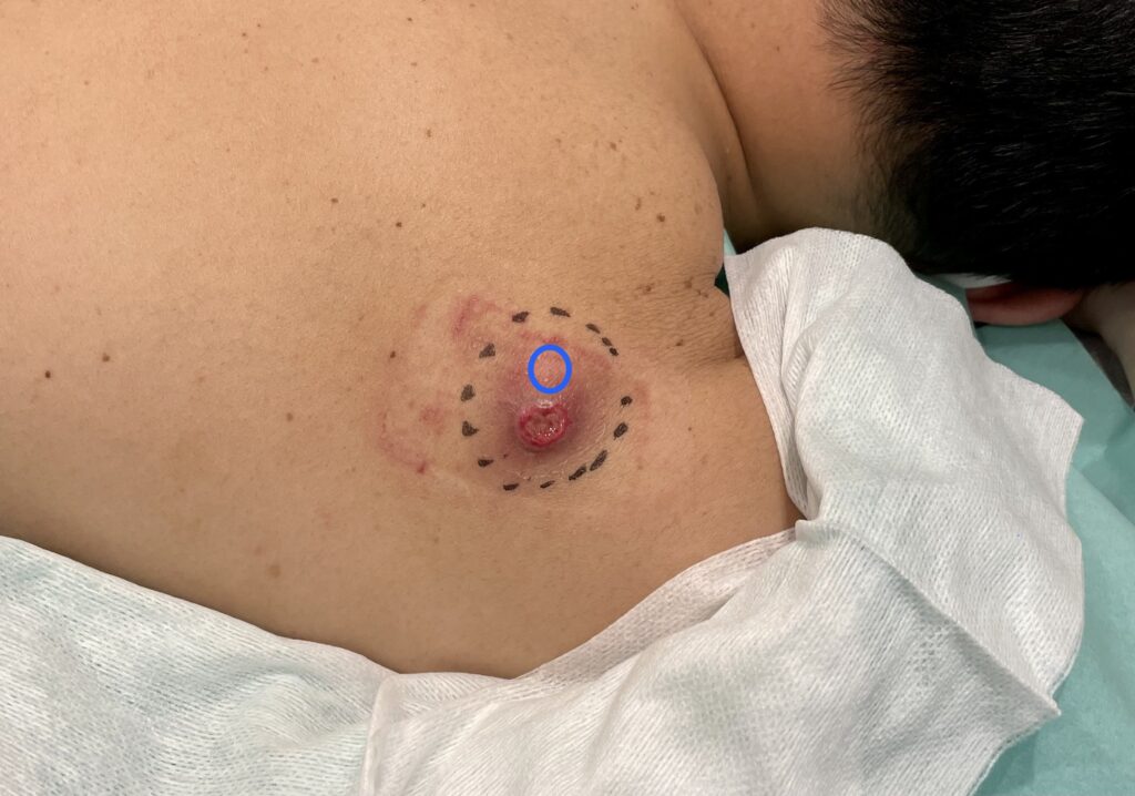 炎症性粉瘤の開口部