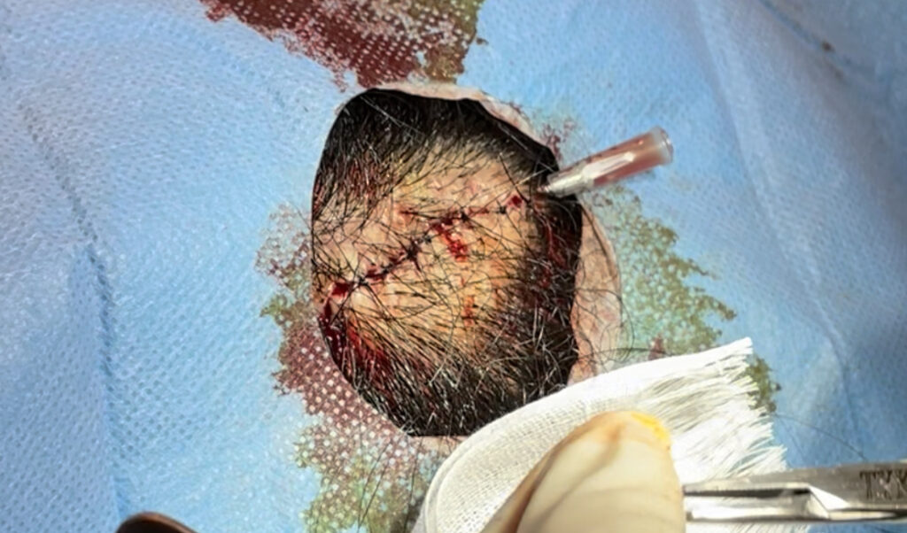 頭部粉瘤 閉創時