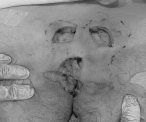 毛巣洞 摘出時の画像