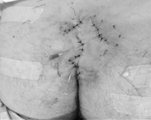 毛巣洞 閉創時の画像