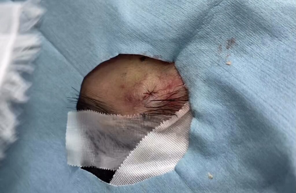 顔 粉瘤 摘出後