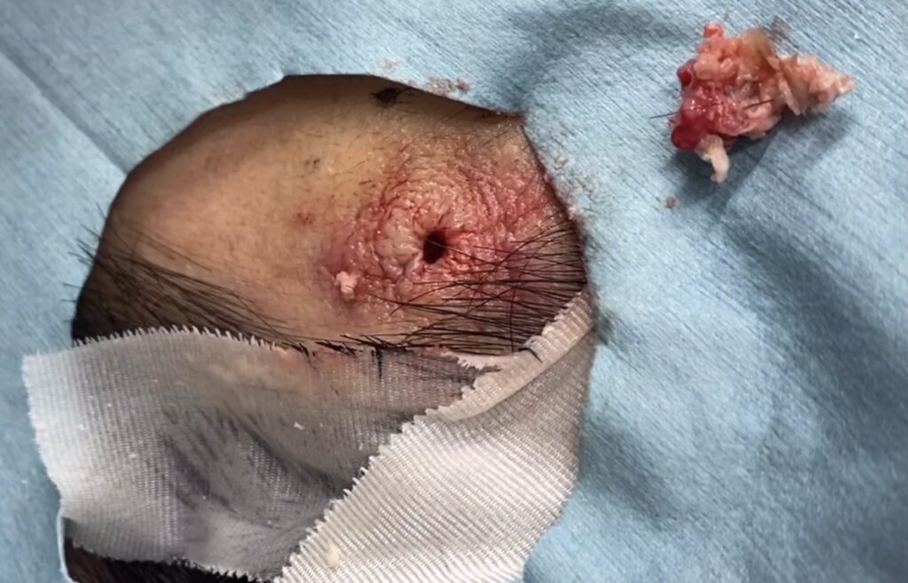 顔の粉瘤 摘出後