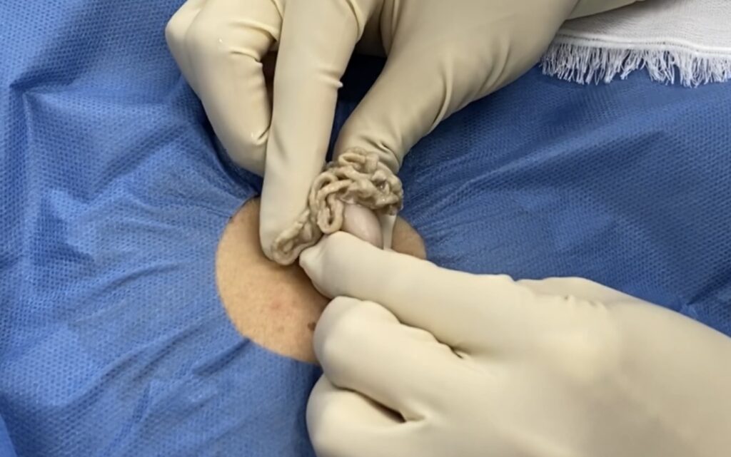 背部の粉瘤 術中写真