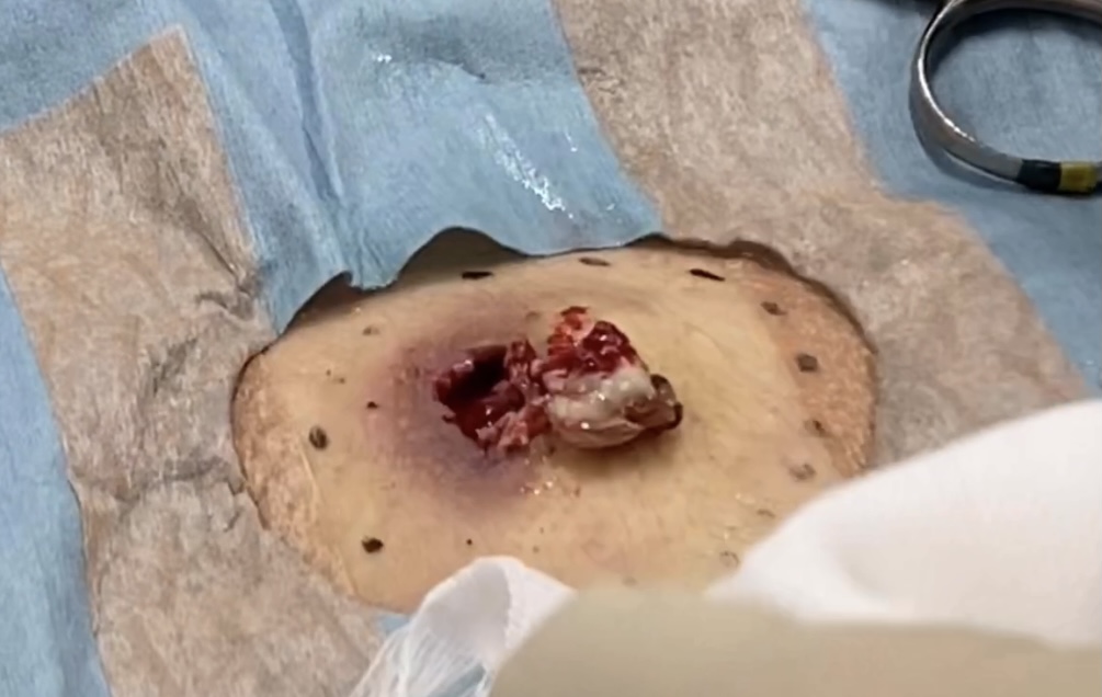 炎症した 粉瘤 取り出し