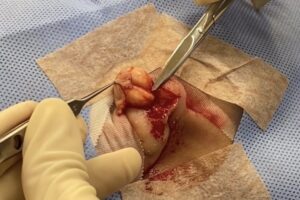 耳のの粉瘤 摘出画像