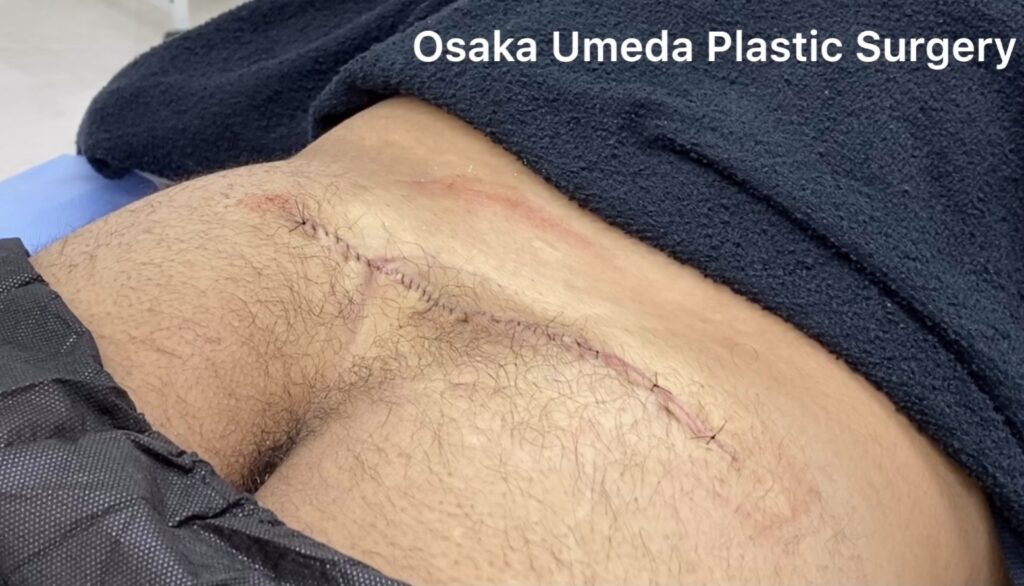 術後写真 臀部 粉瘤