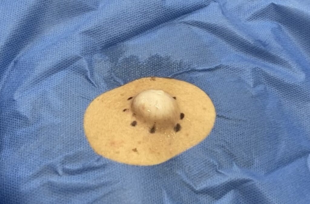 背部の粉瘤 麻酔時