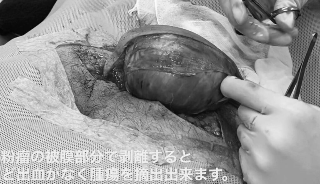 術中画像 臀部粉瘤 お尻