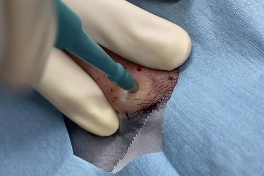 顔の粉瘤 パンチによるくりぬき法