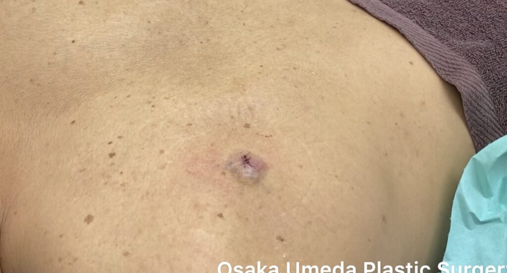 背部 粉瘤 摘出後 創部