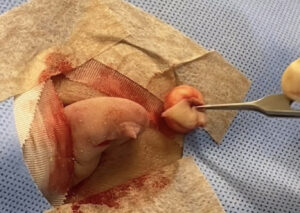 耳の粉瘤 摘出時