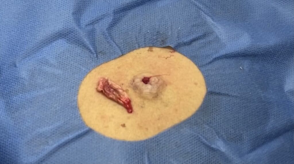 背部の粉瘤 摘出