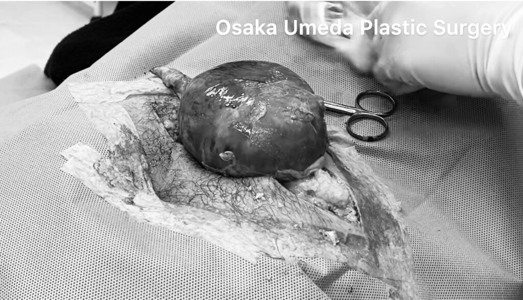 臀部の粉瘤 術中写真