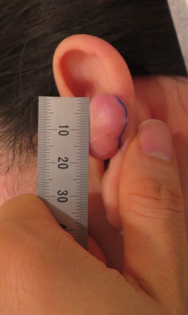 耳のケロイド 裏面