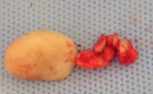 耳のケロイド 切除した組織