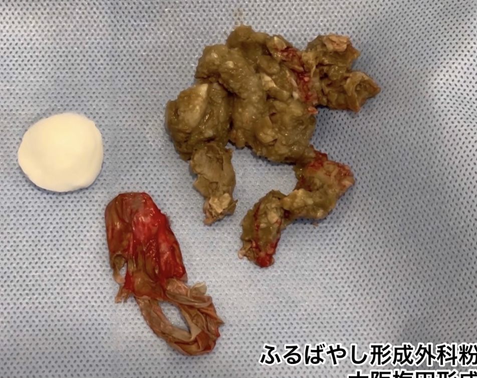 首にできた粉瘤