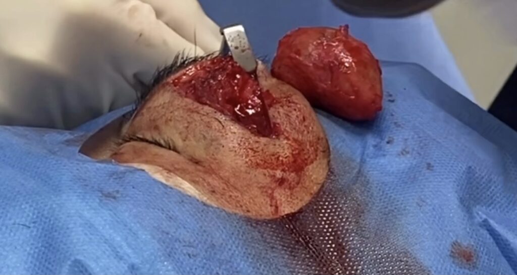 デルモイドシストの手術