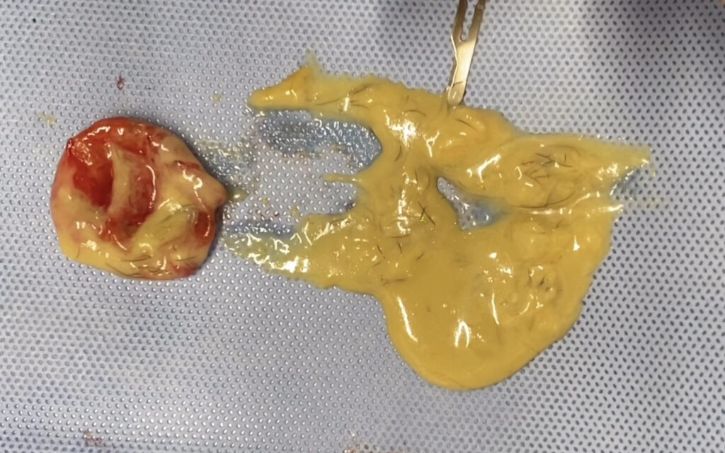 デルモイドシストの手術