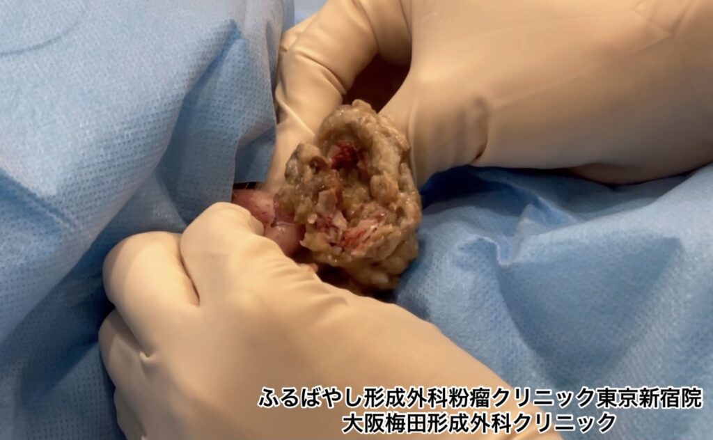 首にできた粉瘤