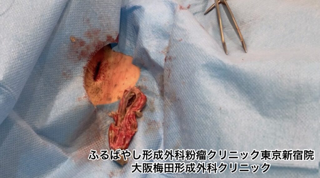 首にできた粉瘤