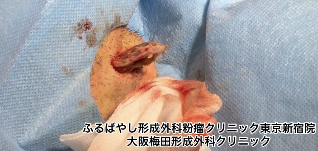 首にできた粉瘤