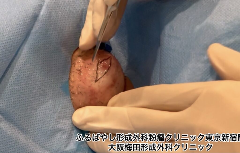 首にできた粉瘤