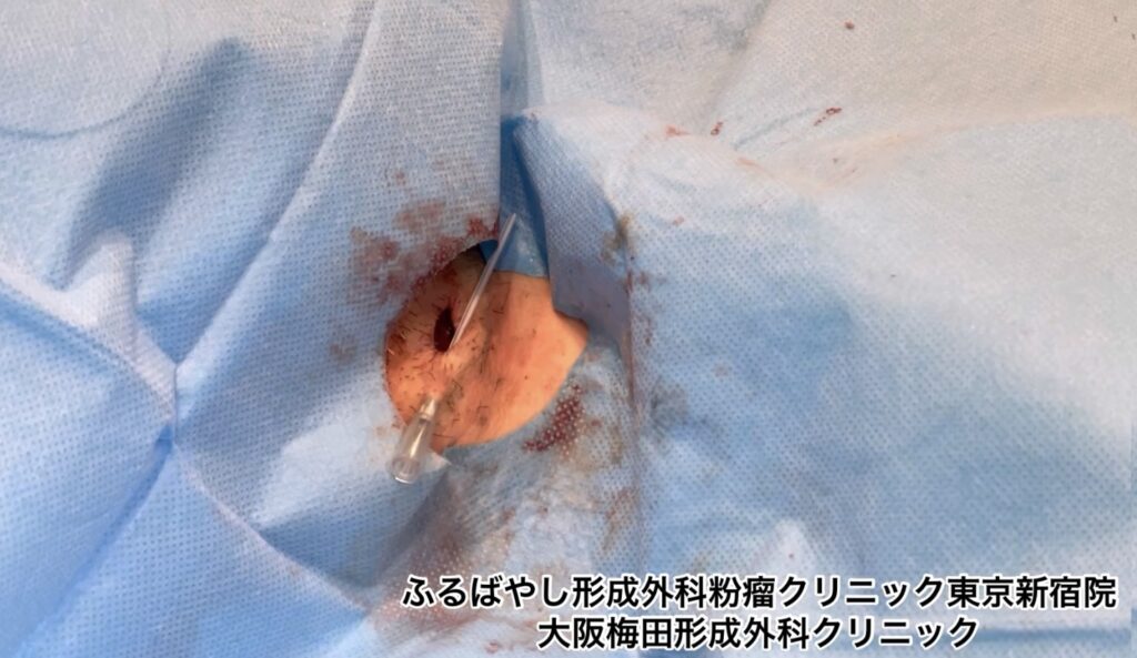 首にできた粉瘤