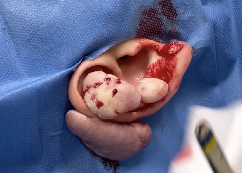 ケロイドを残さずに切除