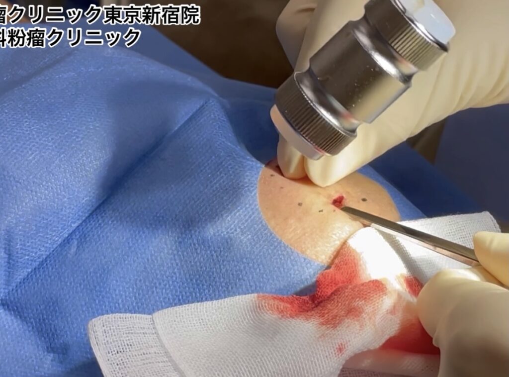 おでこの外骨腫　