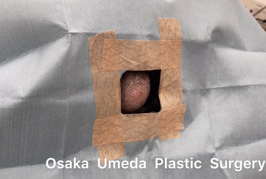 頭部 外毛根鞘性嚢腫