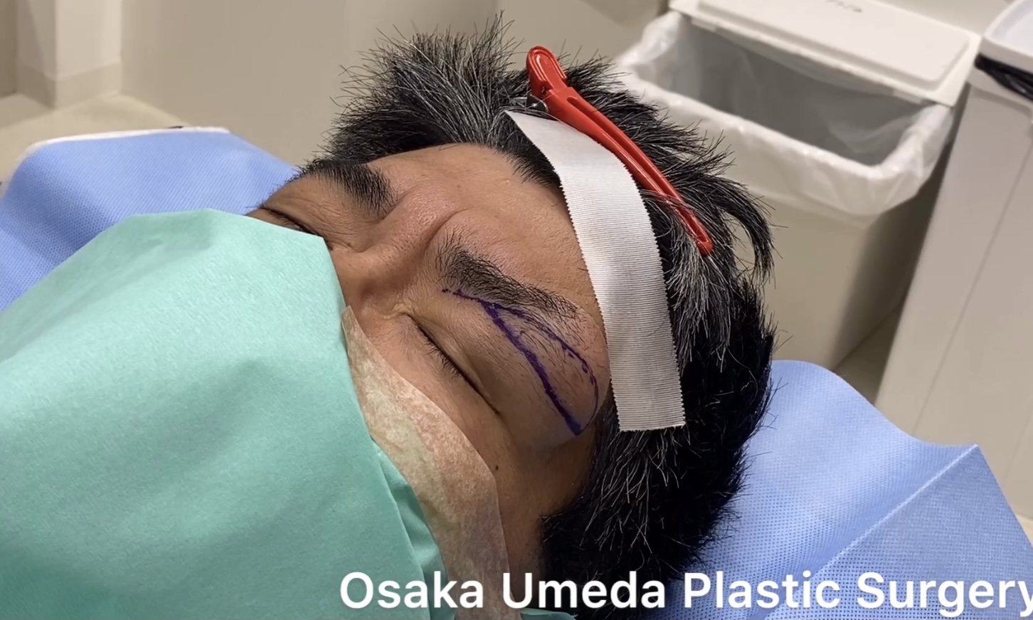 デルモイドシスト　dermoid cyst