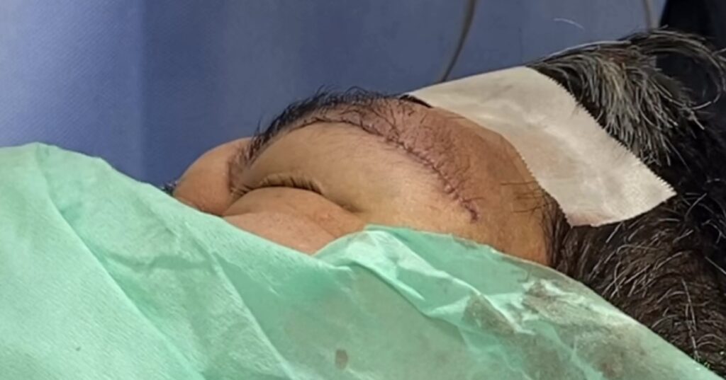 デルモイドシストの手術