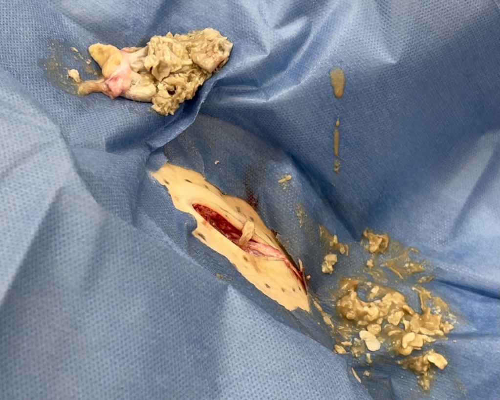 摘出された腫瘍