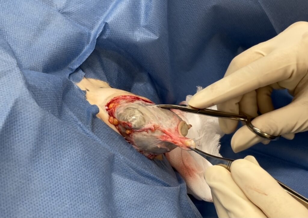 肩にできた粉瘤