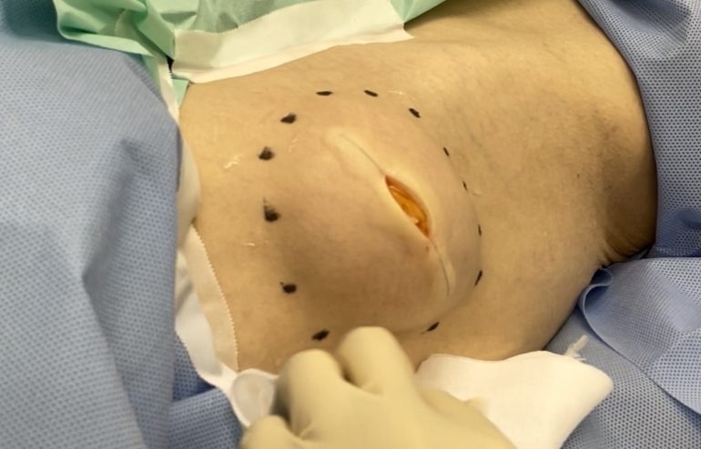 大腿部の脂肪腫