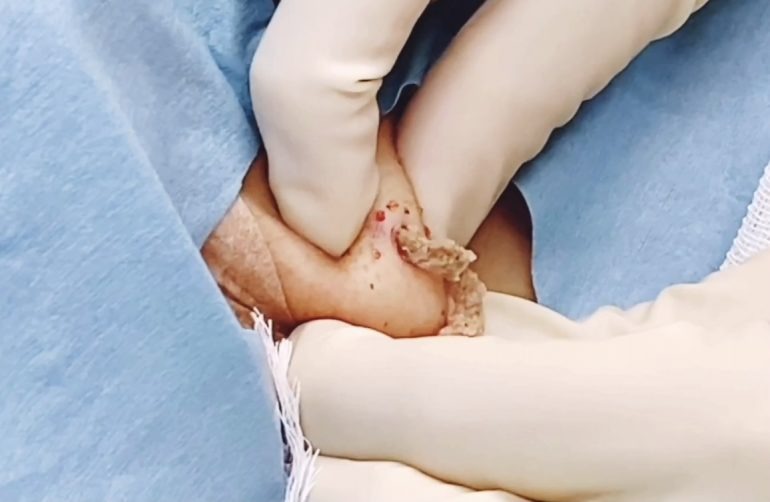 首の粉瘤 術中画像