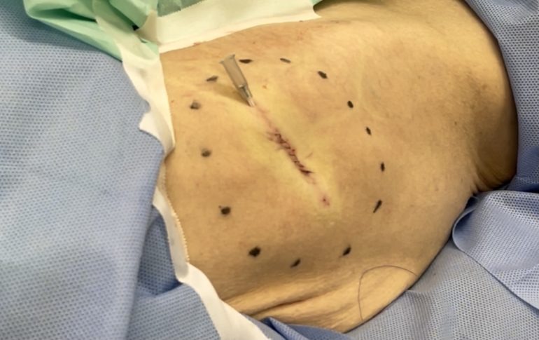 大腿部の脂肪腫