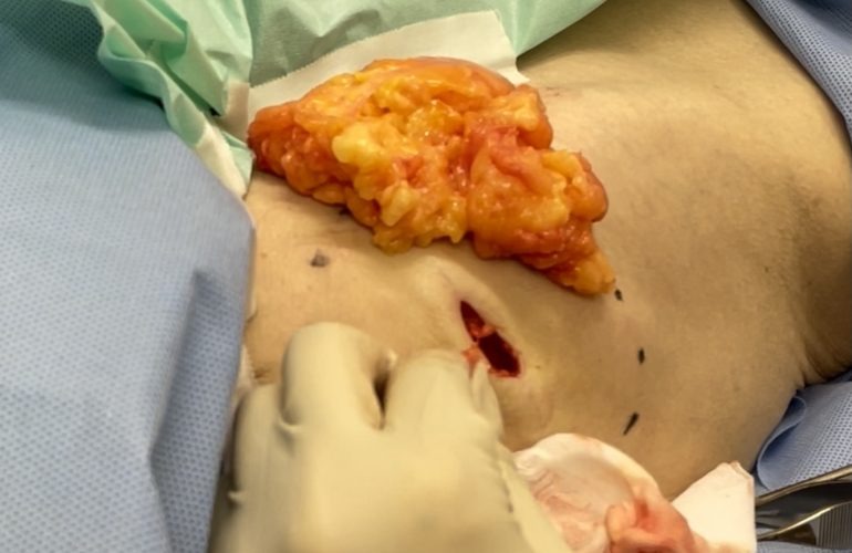 大腿部の脂肪腫