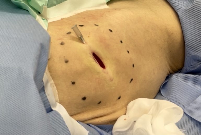 大腿部の脂肪腫