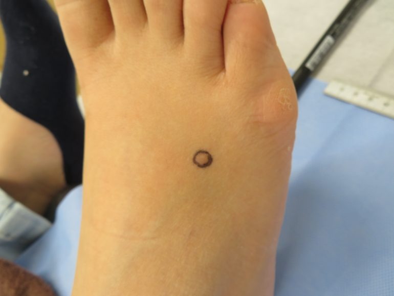 足背の皮膚線維腫