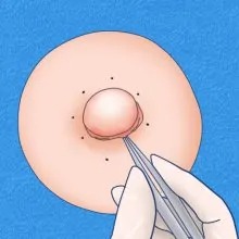 老廃物などの内容物を取り除きます。